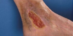 Veneuze ulcus en compressietherapie